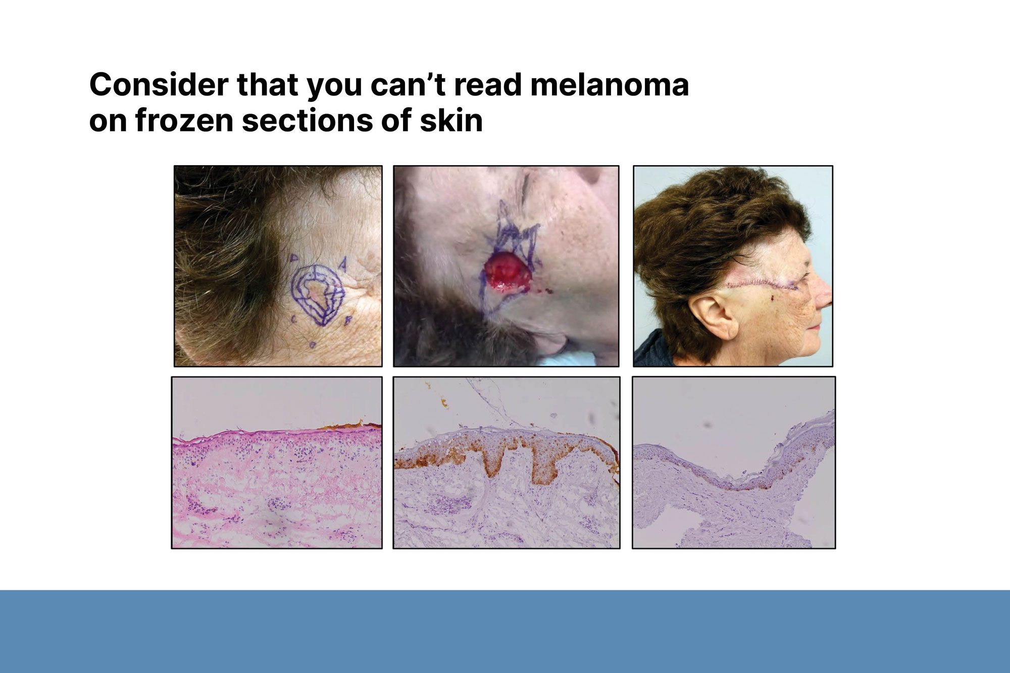 Mohs surgery decreases the local recurrence of melanoma