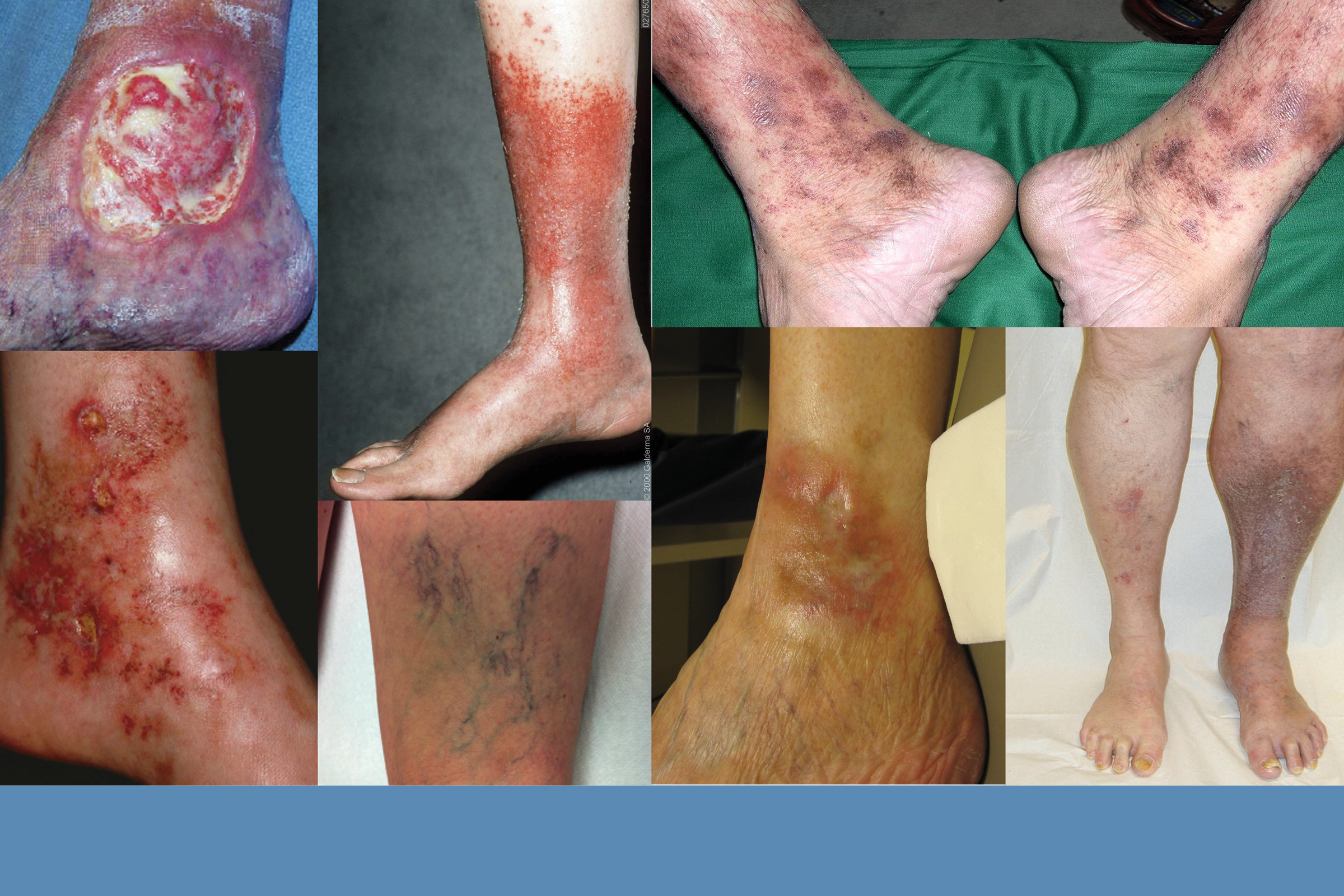 Varicose Veins