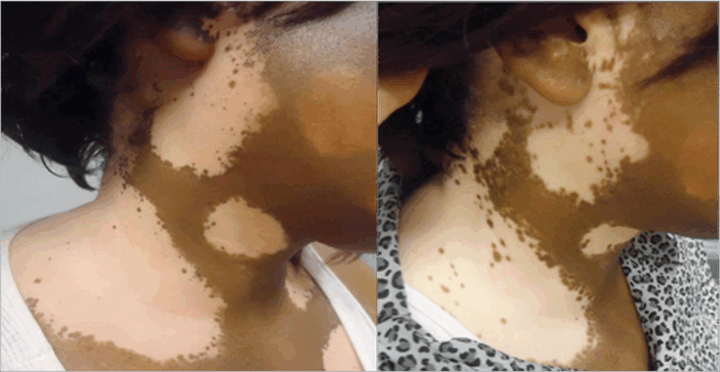 Before and after image of Black woman with skin depigmentation.