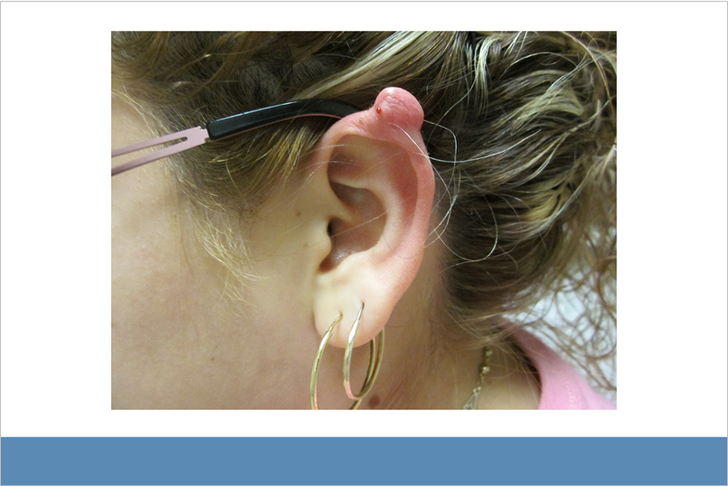 Side view of woman's face with a protrusion