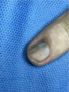 Image of a diseased nail
