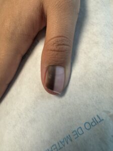 Image of a diseased nail