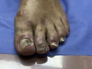 Diseased toe nails